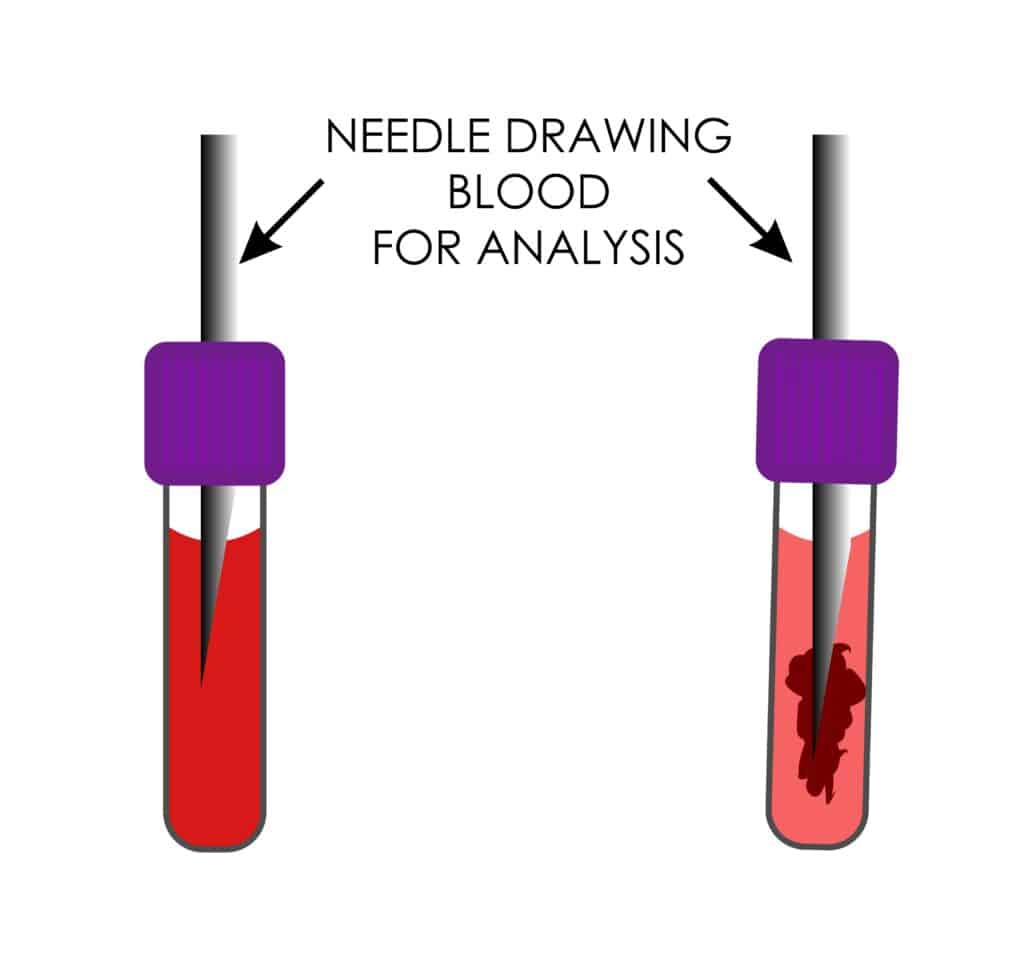 clot in morphology, drawing blood